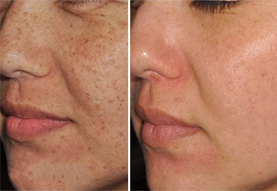 IPL Photo facial - For hyperpigmented (freckled or age spots) skin
