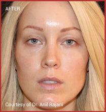 Load image into Gallery viewer, EZ Gel - All Natural Facial Filler