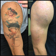Load image into Gallery viewer, Tattoo Removal - Laser PICO Discovery