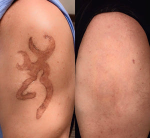 Tattoo Removal - Laser PICO Discovery