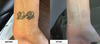 Tattoo Removal - Laser PICO Discovery